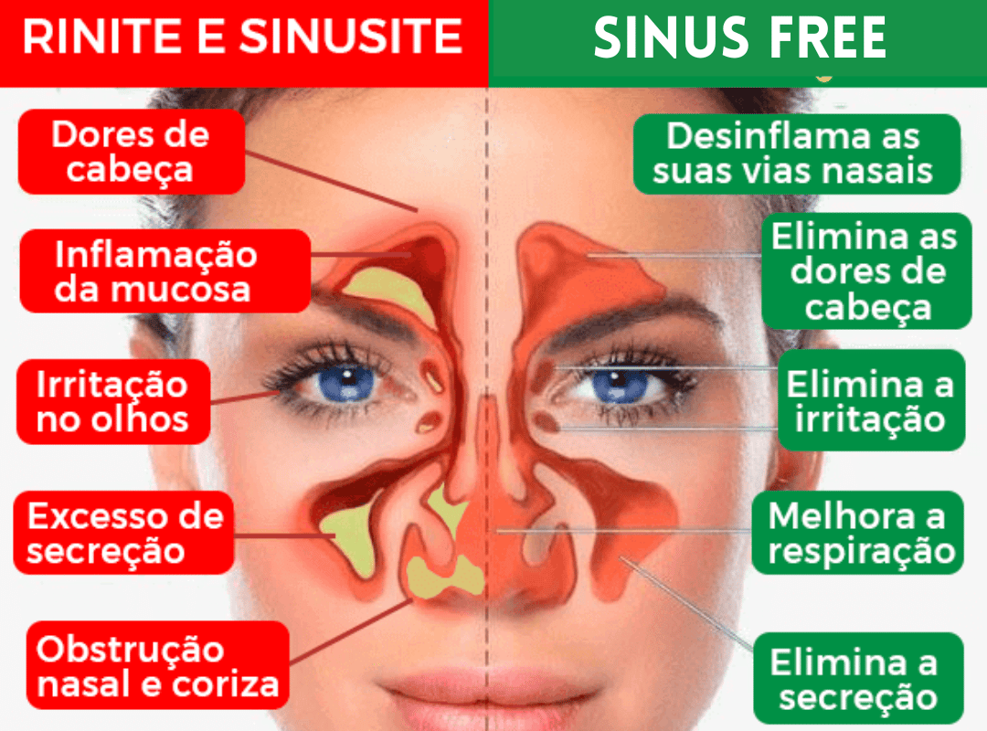 SINUS FREE COMPARATIVO